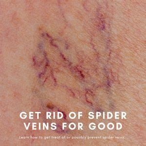spider vein mt juliet tn|Mt. Juliet Vein Centre .
